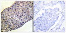 RHOA Antibody - Immunohistochemistry analysis of paraffin-embedded human breast carcinoma tissue, using RhoA Antibody. The picture on the right is blocked with the synthesized peptide.