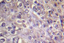 RHOA Antibody - IHC of Rho A (R182) pAb in paraffin-embedded human breast carcinoma tissue.