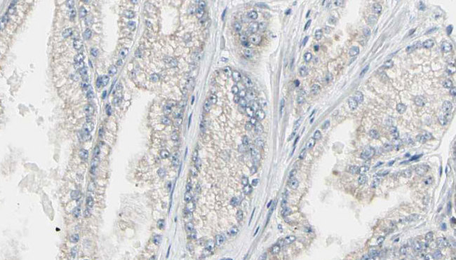 RHOA Antibody - 1:100 staining human prostate tissue by IHC-P. The sample was formaldehyde fixed and a heat mediated antigen retrieval step in citrate buffer was performed. The sample was then blocked and incubated with the antibody for 1.5 hours at 22°C. An HRP conjugated goat anti-rabbit antibody was used as the secondary.