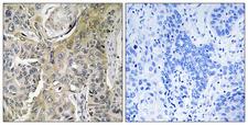 RHOBTB3 Antibody - Immunohistochemistry analysis of paraffin-embedded human lung carcinoma tissue, using RHOBTB3 Antibody. The picture on the right is blocked with the synthesized peptide.
