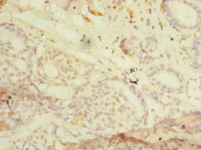 RHOC Antibody - Immunohistochemistry of paraffin-embedded human breast cancer using RHOC Antibody at dilution of 1:100