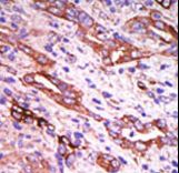 Rhodopsin Kinase / GRK1 Antibody - Formalin-fixed and paraffin-embedded human cancer tissue reacted with the primary antibody, which was peroxidase-conjugated to the secondary antibody, followed by DAB staining. This data demonstrates the use of this antibody for immunohistochemistry; clinical relevance has not been evaluated. BC = breast carcinoma; HC = hepatocarcinoma.