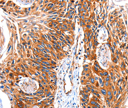Rhodopsin Kinase / GRK1 Antibody - Immunohistochemistry of paraffin-embedded human esophagus cancer tissue.