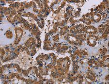 Rhodopsin Kinase / GRK1 Antibody - Immunohistochemistry of paraffin-embedded Human esophagus cancer using GRK1 Polyclonal Antibody at dilution of 1:40.