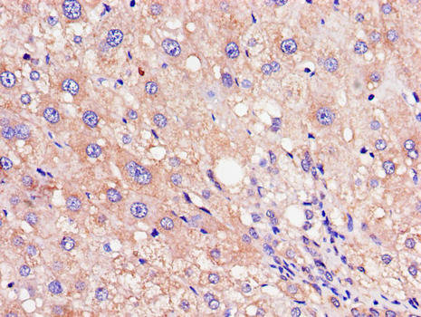 RHOE / RND3 Antibody - Immunohistochemistry of paraffin-embedded human liver cancer using RND3 Antibody at dilution of 1:100