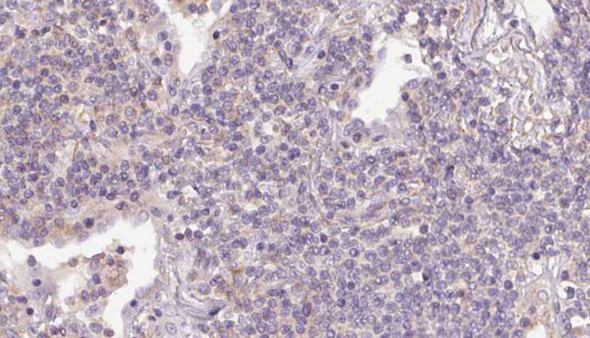 RHOE / RND3 Antibody - 1:100 staining human lymph carcinoma tissue by IHC-P. The sample was formaldehyde fixed and a heat mediated antigen retrieval step in citrate buffer was performed. The sample was then blocked and incubated with the antibody for 1.5 hours at 22°C. An HRP conjugated goat anti-rabbit antibody was used as the secondary.