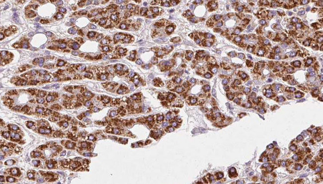 RHOG / ARHG Antibody - 1:100 staining human liver carcinoma tissues by IHC-P. The sample was formaldehyde fixed and a heat mediated antigen retrieval step in citrate buffer was performed. The sample was then blocked and incubated with the antibody for 1.5 hours at 22°C. An HRP conjugated goat anti-rabbit antibody was used as the secondary.
