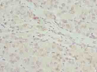 RIBC2 Antibody - Immunohistochemistry of paraffin-embedded human liver cancer using antibody at dilution of 1:100.