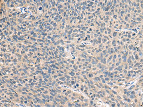 Ribonuclease A / RNASE1 Antibody - Immunohistochemistry of paraffin-embedded Human cervical cancer tissue  using RNASE1 Polyclonal Antibody at dilution of 1:50(×200)