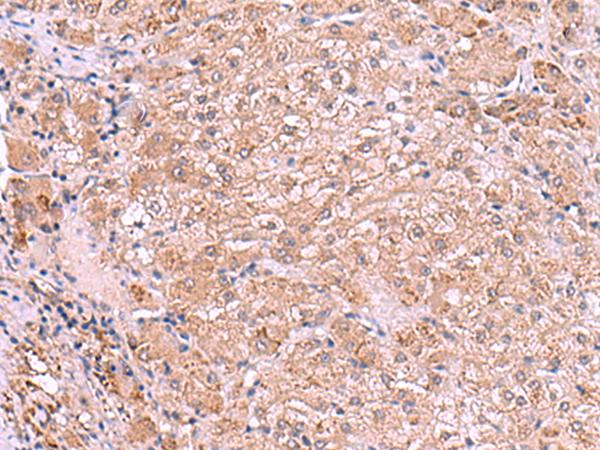 RIC3 Antibody - Immunohistochemistry of paraffin-embedded Human liver cancer tissue  using RIC3 Polyclonal Antibody at dilution of 1:90(×200)