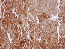 RIC8A Antibody - IHC of paraffin-embedded Adrenal cortical tumor using RIC8A antibody at 1:100 dilution.