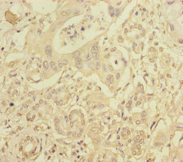 RIC8A Antibody - Immunohistochemistry of paraffin-embedded human pancreatic cancer at dilution of 1:100