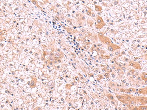 RIC8A Antibody - Immunohistochemistry of paraffin-embedded Human liver cancer tissue  using RIC8A Polyclonal Antibody at dilution of 1:80(×200)