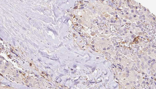 RIC8B Antibody - 1:100 staining human thyroid carcinoma tissue by IHC-P. The sample was formaldehyde fixed and a heat mediated antigen retrieval step in citrate buffer was performed. The sample was then blocked and incubated with the antibody for 1.5 hours at 22°C. An HRP conjugated goat anti-rabbit antibody was used as the secondary.