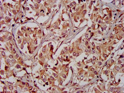 RICK / RIP2 Antibody - IHC image of RIPK2 Antibody diluted at 1:400 and staining in paraffin-embedded human liver cancer performed on a Leica BondTM system. After dewaxing and hydration, antigen retrieval was mediated by high pressure in a citrate buffer (pH 6.0). Section was blocked with 10% normal goat serum 30min at RT. Then primary antibody (1% BSA) was incubated at 4°C overnight. The primary is detected by a biotinylated secondary antibody and visualized using an HRP conjugated SP system.