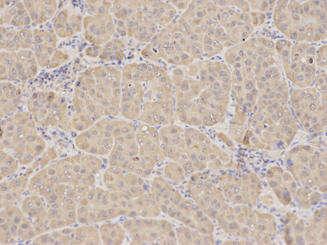 RICK / RIP2 Antibody - Immunohistochemistry of paraffin-embedded human liver cancer using RIPK2 antibody at dilution of 1:100 (200x lens).