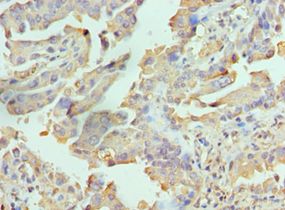 RICTOR Antibody - Immunohistochemistry of paraffin-embedded human lung cancer using antibody at 1:100 dilution.