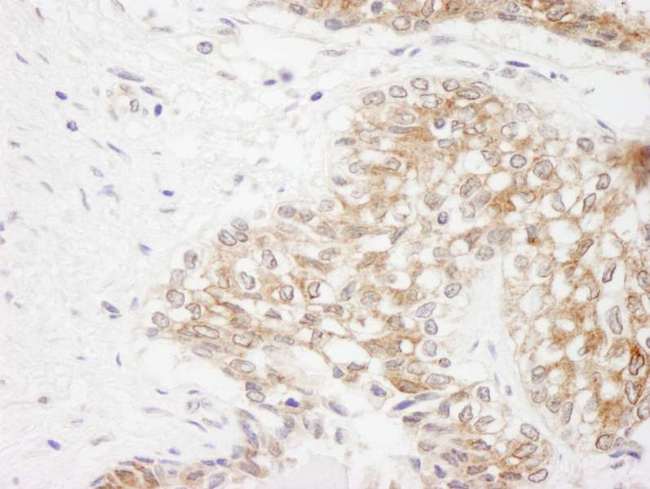 RICTOR Antibody - Detection of Human Rictor by Immunohistochemistry. Sample: FFPE section of human prostate carcinoma Antibody: Affinity purified rabbit anti-Rictor used at a dilution of 1:250.