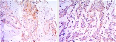 RICTOR Antibody - Immunohistochemistry-Paraffin: RICTOR Antibody (7B3) - Immunohistochemical analysis of paraffin-embedded thyroid gland tissues (left) and human breast carcinoma (right) using RICTOR mouse mAb with DAB staining.