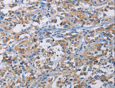 RICTOR Antibody - Immunohistochemistry of paraffin-embedded Human liver cancer using RICTOR Polyclonal Antibody at dilution of 1:50.