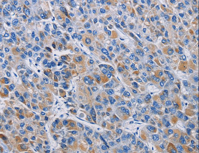 RICTOR Antibody - Immunohistochemistry of paraffin-embedded Human liver cancer using RICTOR Polyclonal Antibody at dilution of 1:50.