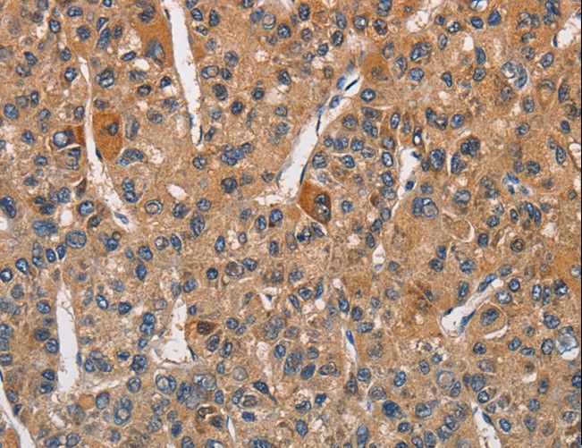 RICTOR Antibody - Immunohistochemistry of paraffin-embedded Human liver cancer using RICTOR Polyclonal Antibody at dilution of 1:40.