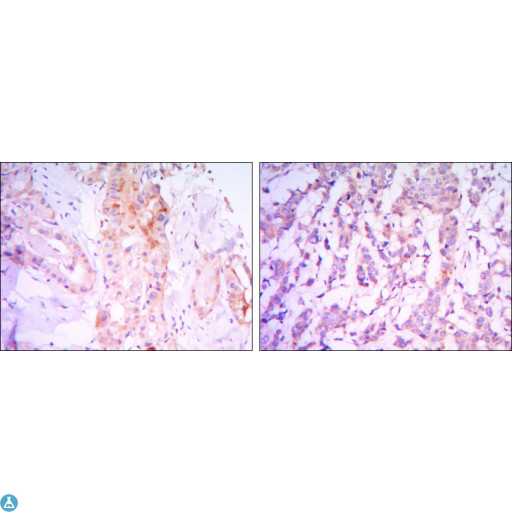 RICTOR Antibody - Immunohistochemistry (IHC) analysis of paraffin-embedded thyroid gland tissues (left) and Human Breast Carcinoma (right) with DAB staining using Rictor Monoclonal Antibody.