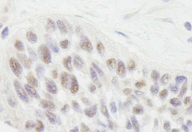RIF1 Antibody - Detection of Human RIF1 by Immunohistochemistry. Sample: FFPE section of human laryngeal squamous cell carcinoma. Antibody: Affinity purified rabbit anti- RIF1 used at a dilution of 1:1000 (1 Detection: DAB.