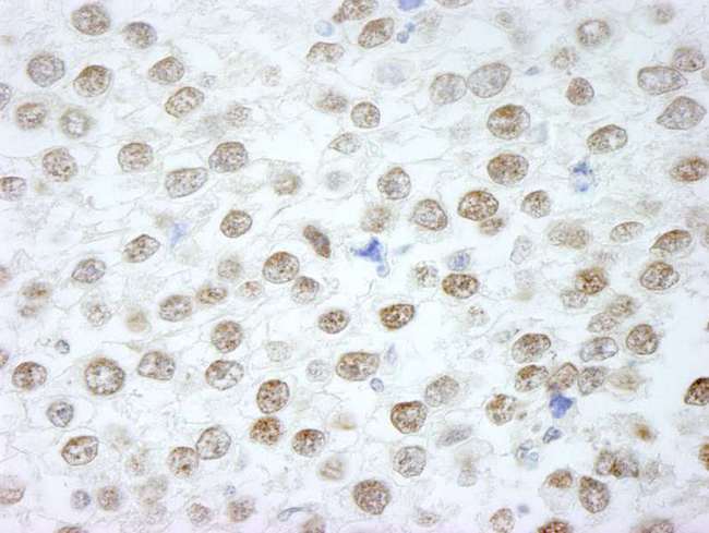 RIF1 Antibody - Detection of Human RIF1 by Immunohistochemistry. Sample: FFPE section of human seminoma. Antibody: Affinity purified rabbit anti-RIF1 used at a dilution of 1:250.
