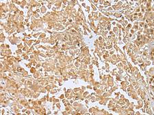 RILPL2 Antibody - Immunohistochemistry of paraffin-embedded Human colorectal cancer tissue  using RILPL2 Polyclonal Antibody at dilution of 1:30(×200)