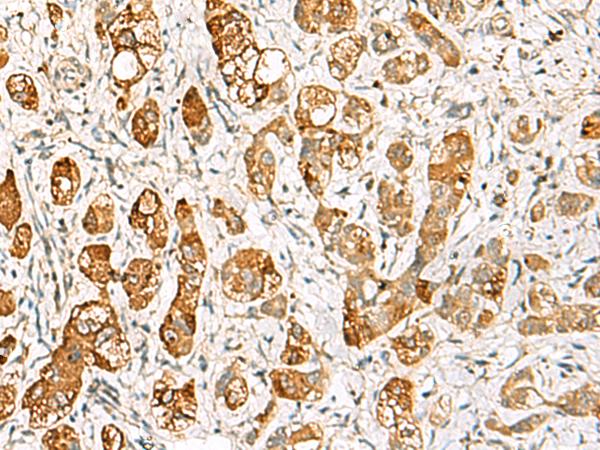 RIMS3 Antibody - Immunohistochemistry of paraffin-embedded Human liver cancer tissue  using RIMS3 Polyclonal Antibody at dilution of 1:60(×200)