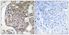 RIMS4 Antibody - Peptide - + Immunohistochemistry analysis of paraffin-embedded human breast carcinoma tissue using RIMS4 antibody.