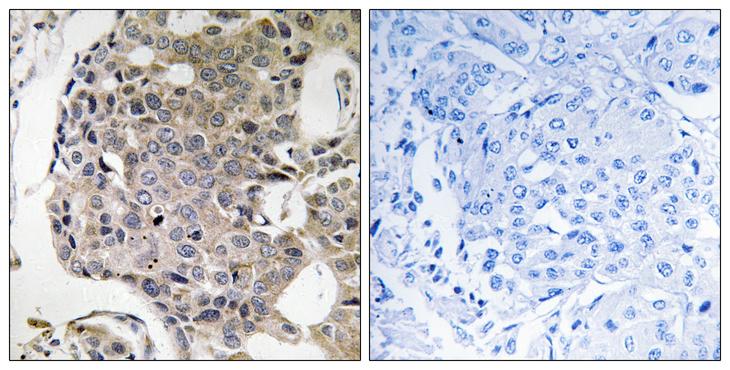 RIMS4 Antibody - Peptide - + Immunohistochemistry analysis of paraffin-embedded human breast carcinoma tissue using RIMS4 antibody.