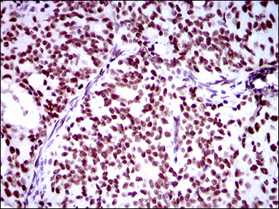 RING1 Antibody - IHC of paraffin-embedded cervical cancer tissues using Ring1 mouse monoclonal antibody with DAB staining.