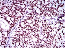 RING1 Antibody - IHC of paraffin-embedded cervical cancer tissues using Ring1 mouse monoclonal antibody with DAB staining.