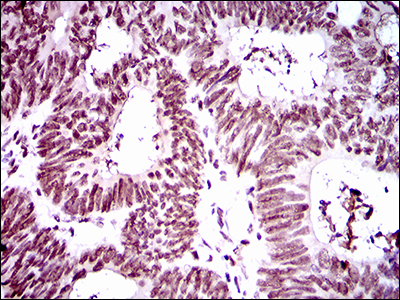 RING1 Antibody - IHC of paraffin-embedded rectum cancer tissues using Ring1 mouse monoclonal antibody with DAB staining.