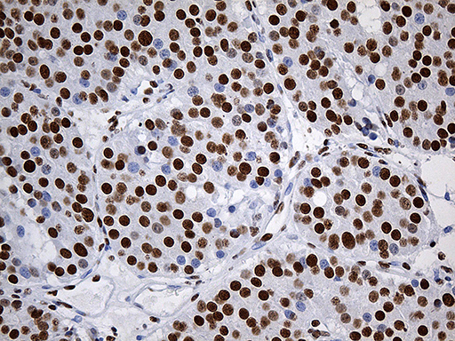 RING1 Antibody - Immunohistochemical staining of paraffin-embedded Carcinoma of Human pancreas tissue using anti-RING1 mouse monoclonal antibody. (Heat-induced epitope retrieval by 1mM EDTA in 10mM Tris buffer. (pH8.5) at 120°C for 3 min. (1:2000)