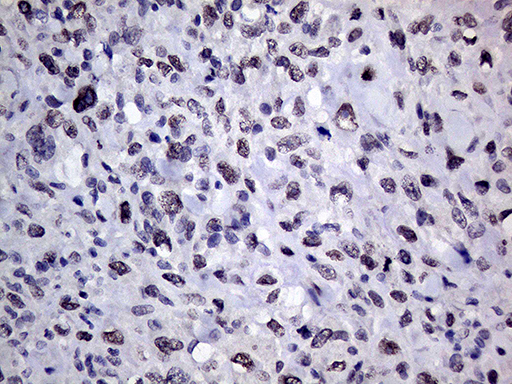 RING1 Antibody - Immunohistochemical staining of paraffin-embedded Adenocarcinoma of Human breast tissue tissue using anti-RING1 mouse monoclonal antibody. (Heat-induced epitope retrieval by 1mM EDTA in 10mM Tris buffer. (pH8.5) at 120°C for 3 min. (1:250)