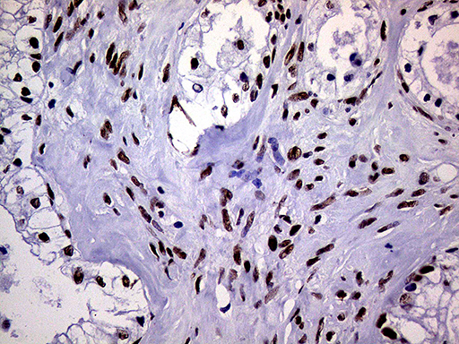 RING1 Antibody - Immunohistochemical staining of paraffin-embedded Adenocarcinoma of Human ovary tissue using anti-RING1 mouse monoclonal antibody. (Heat-induced epitope retrieval by 1mM EDTA in 10mM Tris buffer. (pH8.5) at 120°C for 3 min. (1:1000)