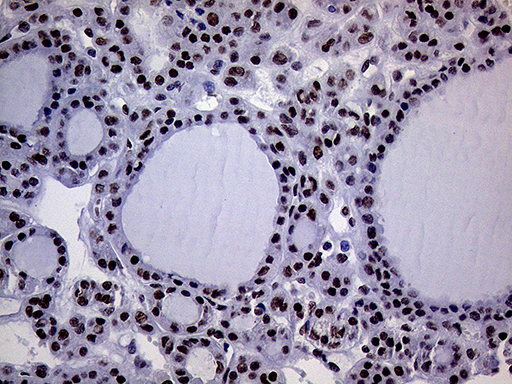 RING1 Antibody - Immunohistochemical staining of paraffin-embedded Carcinoma of Human thyroid tissue using anti-RING1 mouse monoclonal antibody. (Heat-induced epitope retrieval by 1mM EDTA in 10mM Tris buffer. (pH8.5) at 120°C for 3 min. (1:1000)