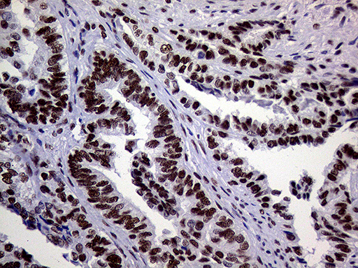 RING1 Antibody - Immunohistochemical staining of paraffin-embedded Adenocarcinoma of Human endometrium tissue using anti-RING1 mouse monoclonal antibody. (Heat-induced epitope retrieval by 1mM EDTA in 10mM Tris buffer. (pH8.5) at 120°C for 3 min. (1:1000)