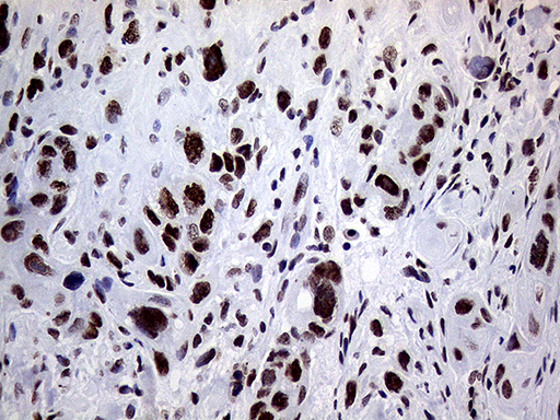 RING1 Antibody - Immunohistochemical staining of paraffin-embedded Adenocarcinoma of Human breast tissue tissue using anti-RING1 mouse monoclonal antibody. (Heat-induced epitope retrieval by 1mM EDTA in 10mM Tris buffer. (pH8.5) at 120°C for 3 min. (1:1000)