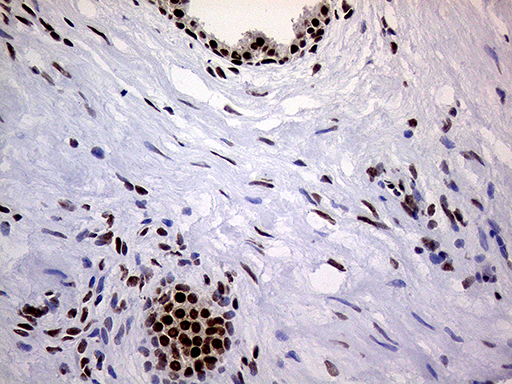 RING1 Antibody - Immunohistochemical staining of paraffin-embedded Carcinoma of Human prostate tissue using anti-RING1 mouse monoclonal antibody. (Heat-induced epitope retrieval by 1mM EDTA in 10mM Tris buffer. (pH8.5) at 120°C for 3 min. (1:1000)
