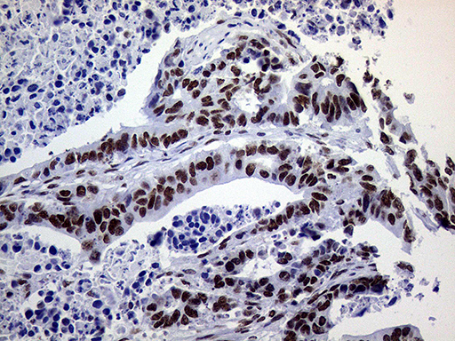 RING1 Antibody - Immunohistochemical staining of paraffin-embedded Adenocarcinoma of Human colon tissue using anti-RING1 mouse monoclonal antibody. (Heat-induced epitope retrieval by 1mM EDTA in 10mM Tris buffer. (pH8.5) at 120°C for 3 min. (1:1000)