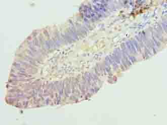 RINT1 Antibody - Immunohistochemistry of paraffin-embedded human ovarian cancer using antibody at dilution of 1:100.