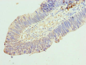 RINT1 Antibody - Immunohistochemistry of paraffin-embedded human ovarian cancer using RINT1 Antibody at dilution of 1:100
