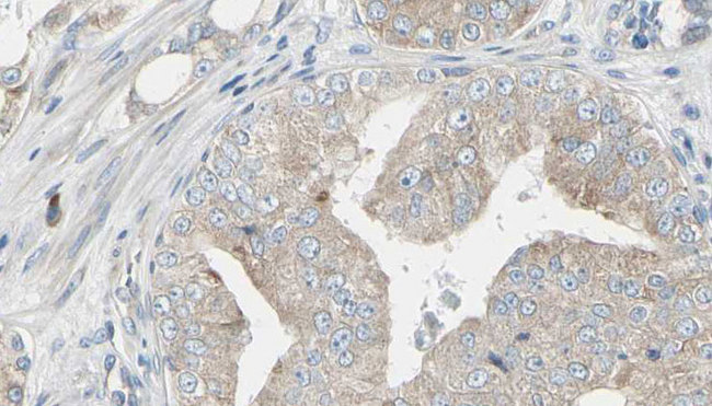 RIOK1 Antibody - 1:100 staining human prostate tissue by IHC-P. The sample was formaldehyde fixed and a heat mediated antigen retrieval step in citrate buffer was performed. The sample was then blocked and incubated with the antibody for 1.5 hours at 22°C. An HRP conjugated goat anti-rabbit antibody was used as the secondary.