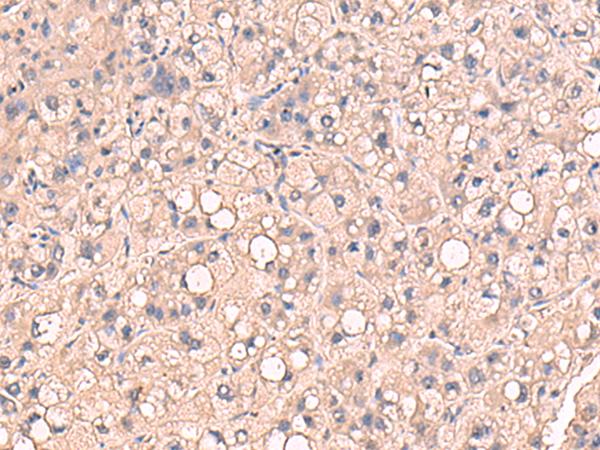 RIOK1 Antibody - Immunohistochemistry of paraffin-embedded Human liver cancer tissue  using RIOK1 Polyclonal Antibody at dilution of 1:80(×200)