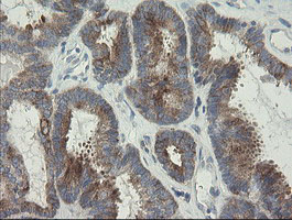 RIOK2 Antibody - IHC of paraffin-embedded Adenocarcinoma of Human endometrium tissue using anti-RIOK2 mouse monoclonal antibody.