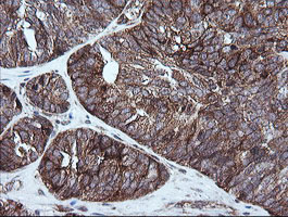 RIOK2 Antibody - IHC of paraffin-embedded Adenocarcinoma of Human ovary tissue using anti-RIOK2 mouse monoclonal antibody.